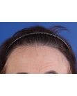 After Hair Transplant &nbsp;Hairline